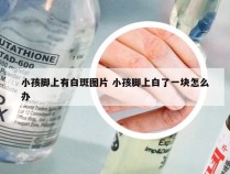 小孩脚上有白斑图片 小孩脚上白了一块怎么办