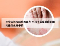 小学生长皮肤癣怎么办 小孩子生皮肤癣的图片是什么样子的