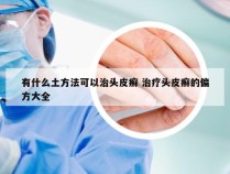 有什么土方法可以治头皮癣 治疗头皮癣的偏方大全