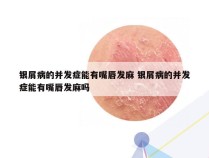 银屑病的并发症能有嘴唇发麻 银屑病的并发症能有嘴唇发麻吗