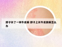 脖子长了一块牛皮癣 脖子上长牛皮肤癣怎么办