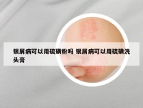 银屑病可以用硫磺粉吗 银屑病可以用硫磺洗头膏