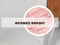 癣的传播途径 癣病传染吗?