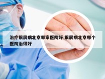 治疗银屑病北京哪家医院好 银屑病北京哪个医院治得好