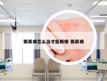 银屑病怎么治才能断根 银屑病