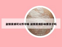 副银屑病可以怀孕嘛 副银屑病影响要孩子吗