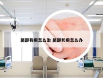 腿部有癣怎么治 腿部长癣怎么办