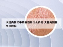 大腿内侧长牛皮癣该用什么药膏 大腿内侧有牛皮肤癣