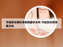 节端型白癜风发展期面积大吗 节段型白斑发展方向