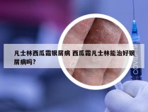 凡士林西瓜霜银屑病 西瓜霜凡士林能治好银屑病吗?