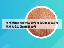 寻常型银屑病影响生命吗 寻常型银屑病会发展成其它类型的银屑病吗