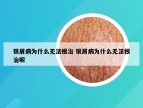 银屑病为什么无法根治 银屑病为什么无法根治呢