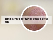 背后面长了好多像干皮的癣 背后长干皮什么原因