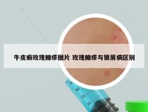 牛皮癣玫瑰糠疹图片 玫瑰糠疹与银屑病区别