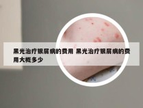 黑光治疗银屑病的费用 黑光治疗银屑病的费用大概多少