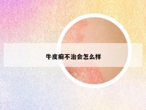 牛皮癣不治会怎么样