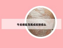 牛皮癣能发展成皮肤癌么