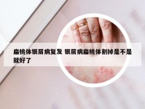 扁桃体银屑病复发 银屑病扁桃体割掉是不是就好了