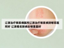 辽源治疗银屑病医院辽源治疗银屑病到哪家医院好 辽源看皮肤病去哪里最好