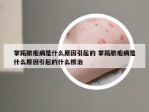 掌跖脓疱病是什么原因引起的 掌跖脓疱病是什么原因引起的什么根治