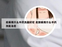 皮癣用什么中药洗最好尼 皮肤癣用什么中药洗能治愈