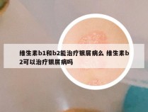 维生素b1和b2能治疗银屑病么 维生素b2可以治疗银屑病吗