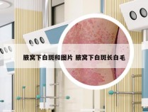 腋窝下白斑和图片 腋窝下白斑长白毛