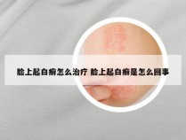 脸上起白癣怎么治疗 脸上起白癣是怎么回事