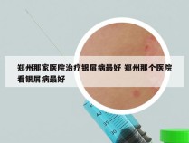 郑州那家医院治疗银屑病最好 郑州那个医院看银屑病最好