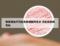 银屑病治疗鸿业皮肤病医院定点 鸿业皮肤病专科