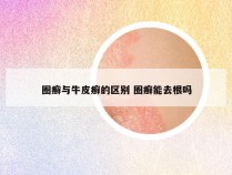 圈癣与牛皮癣的区别 圈癣能去根吗