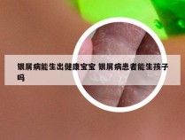 银屑病能生出健康宝宝 银屑病患者能生孩子吗