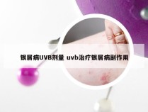 银屑病UVB剂量 uvb治疗银屑病副作用