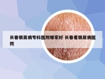 长春银屑病专科医院哪家好 长春看银屑病医院