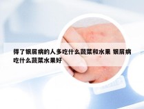 得了银屑病的人多吃什么蔬菜和水果 银屑病吃什么蔬菜水果好