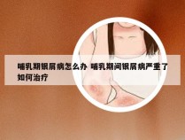 哺乳期银屑病怎么办 哺乳期间银屑病严重了如何治疗