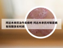 阿达木单抗治牛皮癣吧 阿达木单抗对银屑病有效期多长时间