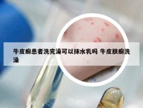 牛皮癣患者洗完澡可以抹水乳吗 牛皮肤癣洗澡