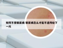 如何不得银屑病 银屑病怎么才能不遗传给下一代