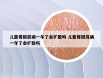 儿童得银屑病一年了会扩散吗 儿童得银屑病一年了会扩散吗