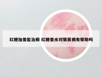 红糖加姜能治癣 红糖姜水对银屑病有帮助吗