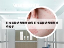 打疫苗能诱发银屑病吗 打疫苗能诱发银屑病吗知乎