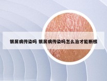 银屑病传染吗 银屑病传染吗怎么治才能断根