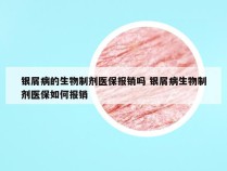 银屑病的生物制剂医保报销吗 银屑病生物制剂医保如何报销