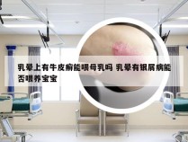 乳晕上有牛皮癣能喂母乳吗 乳晕有银屑病能否喂养宝宝