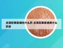 点滴形银屑病吃什么药 点滴型银屑病用什么药膏