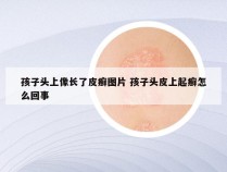 孩子头上像长了皮癣图片 孩子头皮上起癣怎么回事