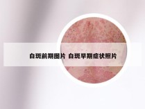 白斑前期图片 白斑早期症状照片