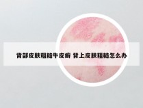 背部皮肤粗糙牛皮癣 背上皮肤粗糙怎么办