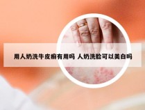 用人奶洗牛皮癣有用吗 人奶洗脸可以美白吗